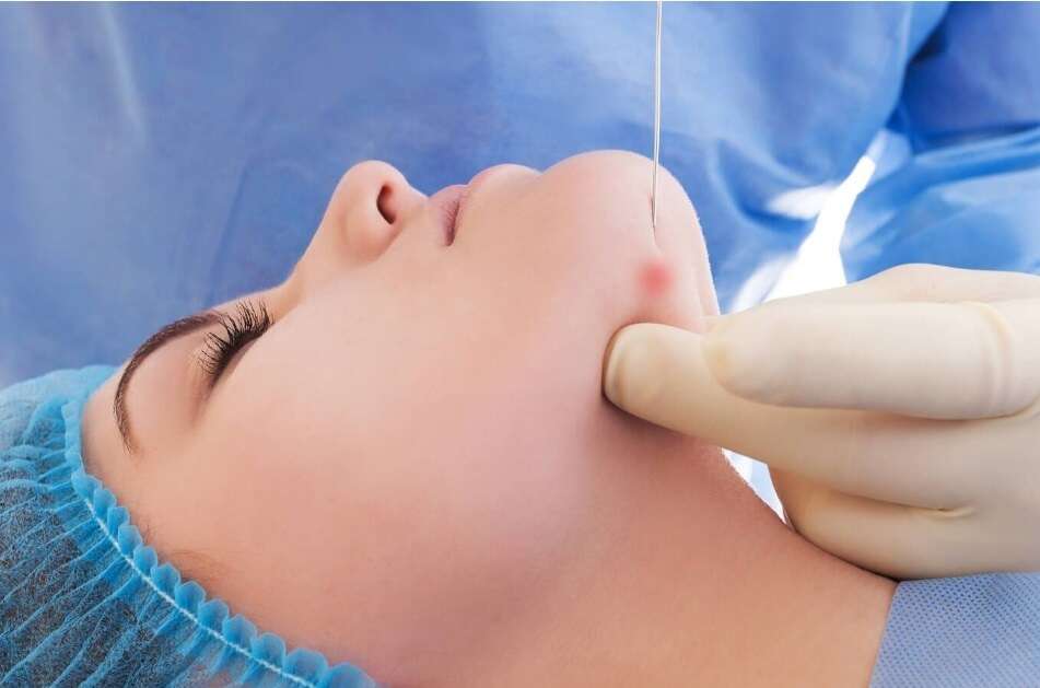 Endolift results